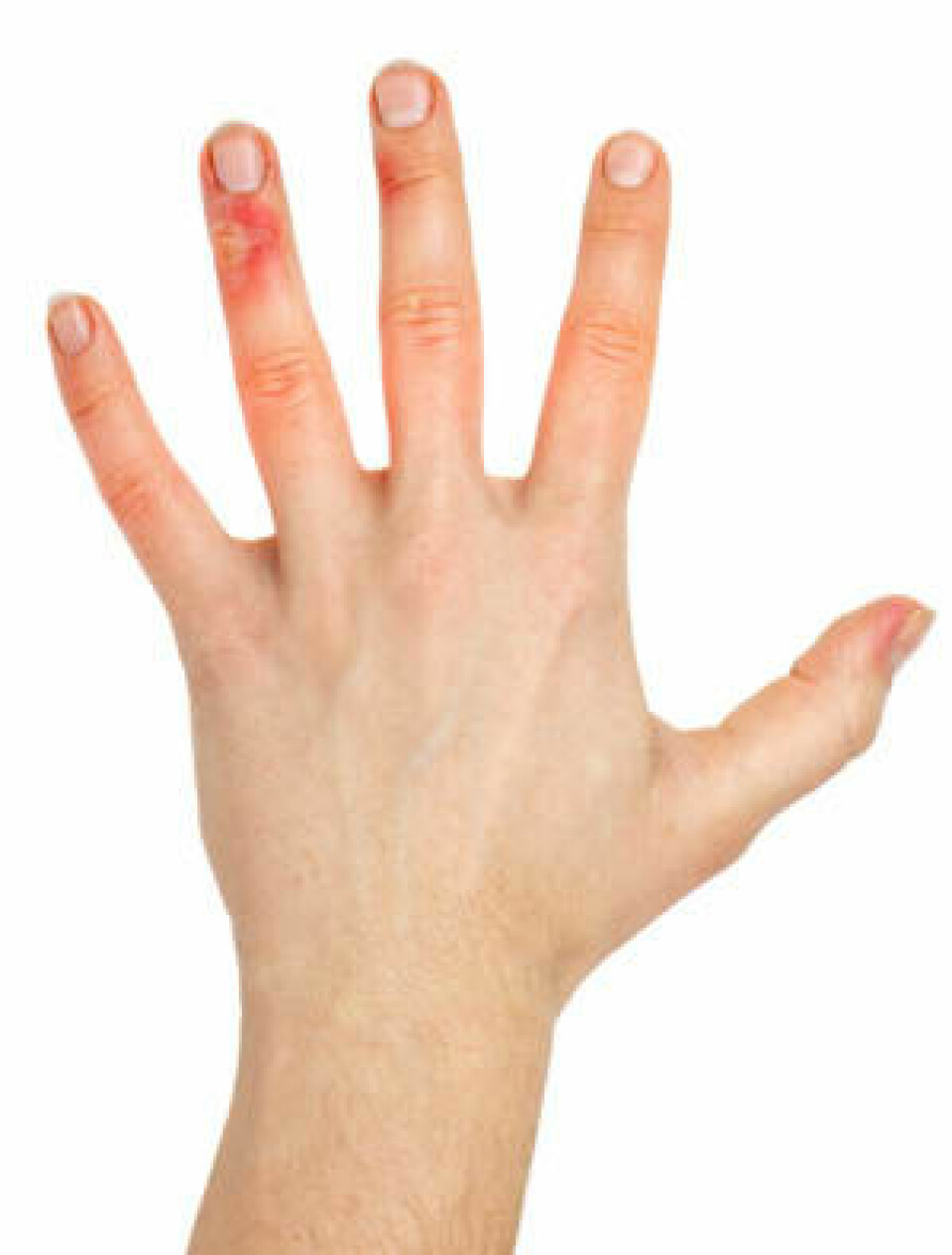 Hånd skade eksem utslett hud