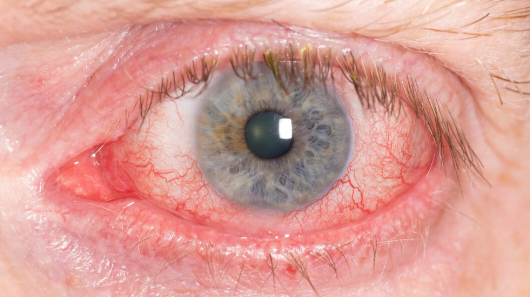 25 til 35 prosent av alle kontor­ansatte har symptomer på tørre øyne. (Ill.foto: Colourbox)