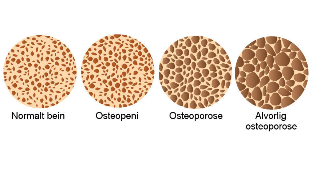 Ulike stadier av osteoporose. (Ill.: Colourbox) Ulike stadier av osteoporose. (Ill.: Colourbox)