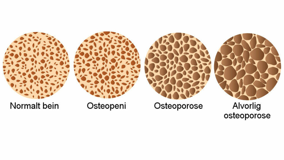 Ulike stadier av osteoporose. (Ill.: Colourbox)